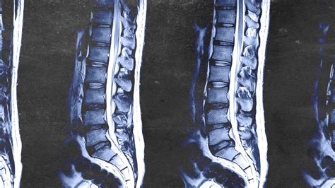 Lumbar Mri Scan How To Read It How Long Does It Take And More