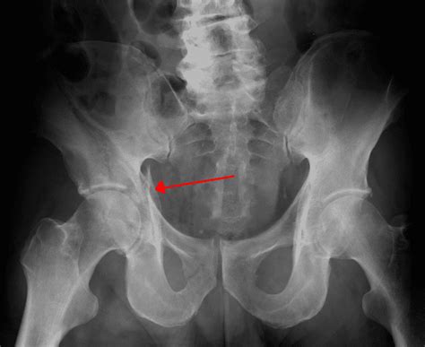 Acetabular Fracture Teachmesurgery