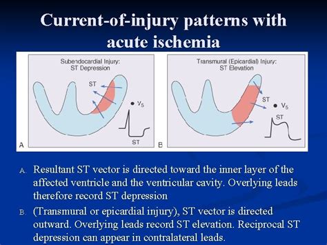 Practical Electrocardiography Myocardial Ischemia And Acute Myocardial