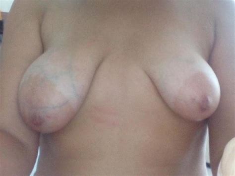 abnormal breasts 31 pics xhamster