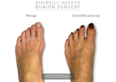 Before And After Photos Akron Podiatrist Dr Nicholas Campitelli