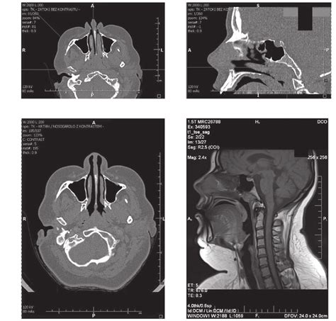 A And B Pre‑operative Computed Tomography Ct Scan Of The