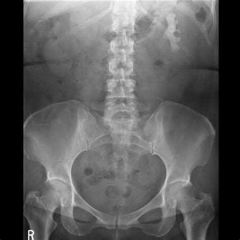 Kidney Stone X Ray Wikidoc