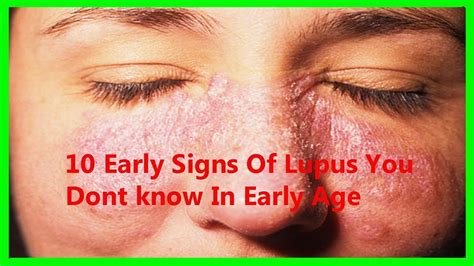 What Is Lupus Disease And Lupus Symptoms 10 Early Signs Of Lupus