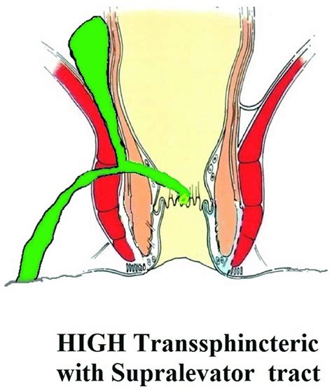 A High Transsphincteric Fistula With Supralevator Extension Download Scientific Diagram
