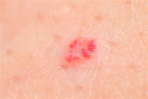 Cherry Angiomas Red Mole Red Mark On Arm Skin Red Dot Suddenly