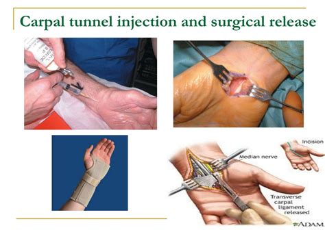 Ppt Hand And Wrist Diseases Carpal Tunnel Syndrome Powerpoint