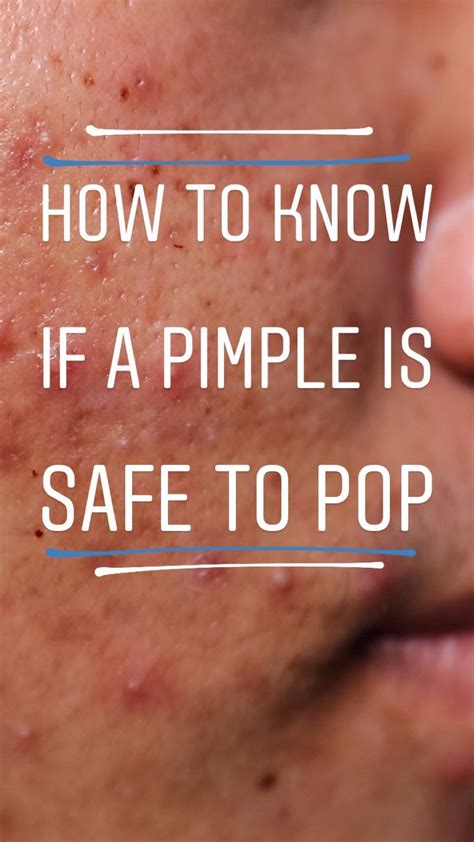 How To Know If A Pimple Is Safe To Pop Or If You Should Just Leave It