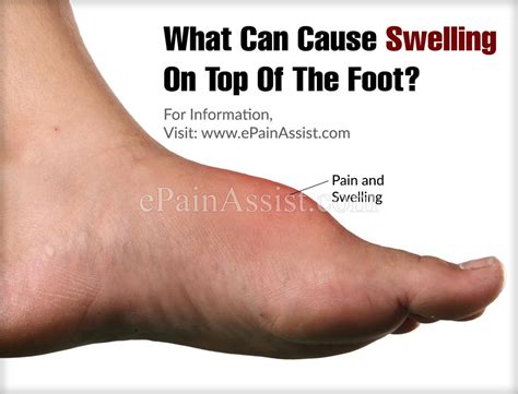 What Can Cause Swelling On Top Of The Foot Swelling Feet Swollen