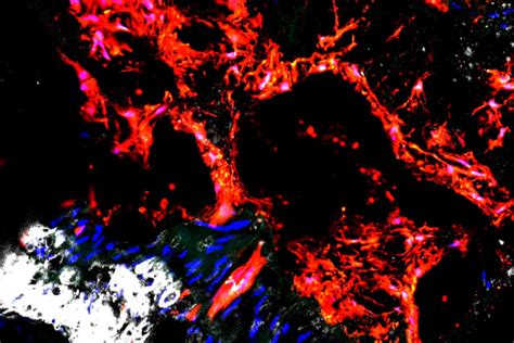 Scientists Find Culprit Responsible For Calcified Blood Vessels In
