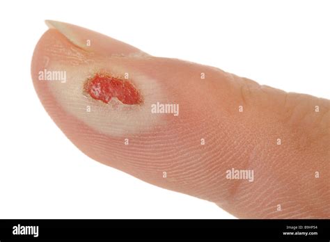 Second Degree Burn Hi Res Stock Photography And Images Alamy
