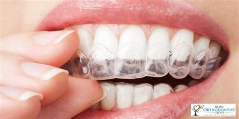 Invisalign Everything You Need To Know Miami Orthodontist Group