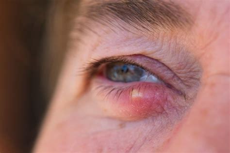 How To Get Rid Of A Stye Fast Quick Guide The Eye News
