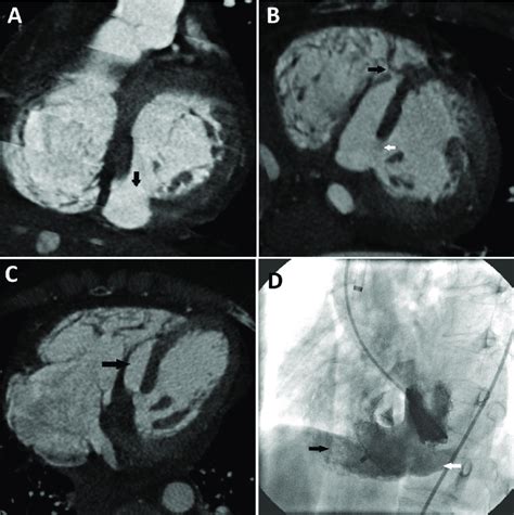 Panel A Cardiac Ct Short Axis View Demonstrating A Rupture In The