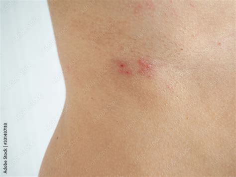 Herpes Zoster Or Shingles In Woman On Her Waist Cause Of Varicella