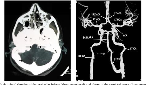 Presented by neuroradiologist dr frank gaillard.find out more. Vertebral artery dissection: Intelligently using CT ...