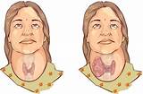 Photos of Medical Definition Of Graves Disease