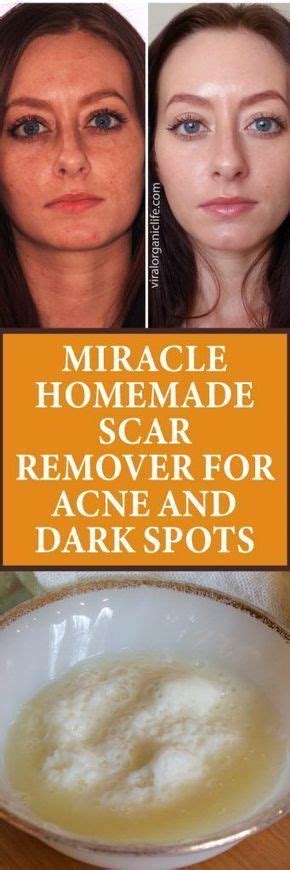 Miracle Homemade Scar Remover For Acne And Dark Spots Darkacnescars