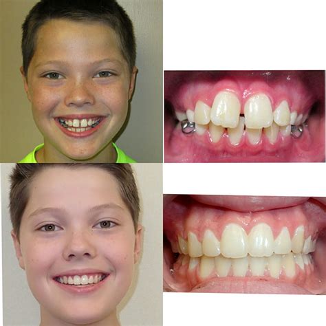 Before And After Braces Wazio Orthodontics