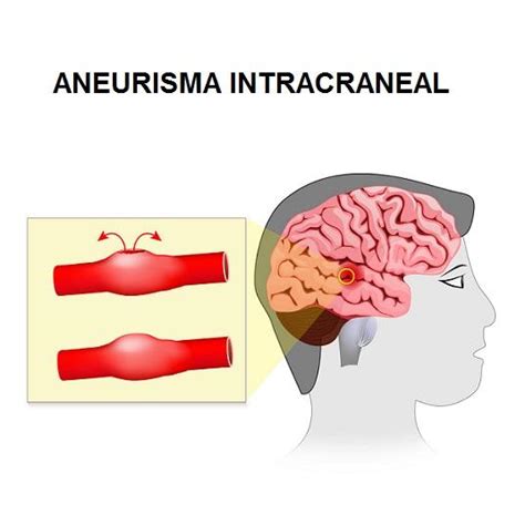 Contrast is then injected, and pictures are taken of all the blood vessels. Aneurisma cerebral: síntomas, causas y tratamientos - Lifeder
