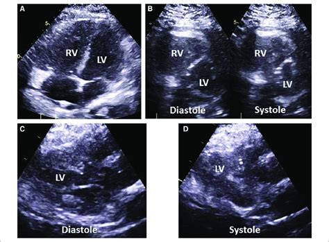 Examples Of Right Ventricular Rv And Left Ventricular Lv