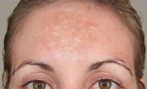 What Is Melasma And How Can Microdermabrasion Help Skinbase