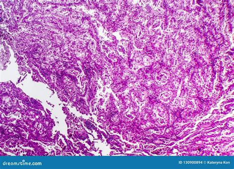 Histopathology Of Lung Cancer Stock Image 130901317
