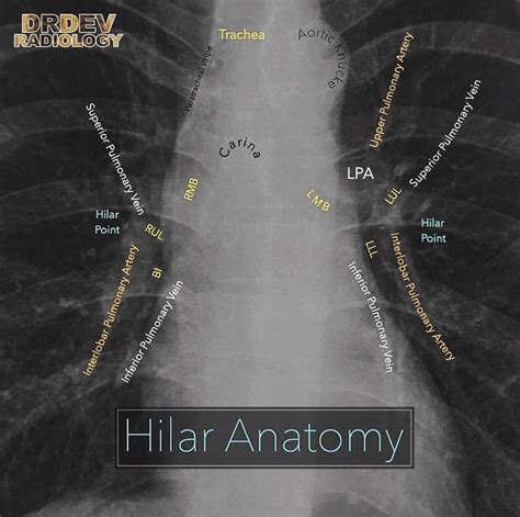 Normal Hilar Anatomy On Chest X Ray The Hilum Is 95 Grepmed