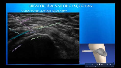 Ultrasound Guided Hip Greater Trochanteric Bursa Injection YouTube