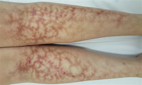 Mottled Skin Or Livedo Reticularis Causes Diagnosis And Treatment