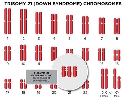 Trisomy 21 Down Syndrome Diagnosis And Expectations