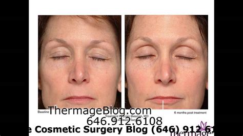 Laser Treatment For Under Eye Wrinkles Youtube