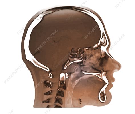 Normal Nasopharynx Ct Scan Stock Image C0551977 Science Photo