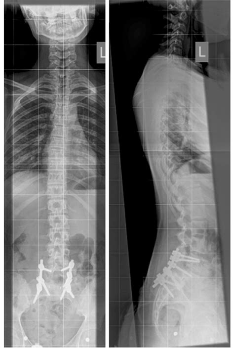 Standing Ap And Lateral Radiographs Showing Resolution Of The Scoliosis