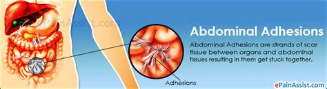 Abdominal Adhesions Treatment Prevention Diet Symptoms Diagnosis