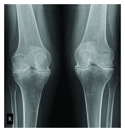 Posteroanterior Radiographic View Of Bilateral Knees Demonstrating