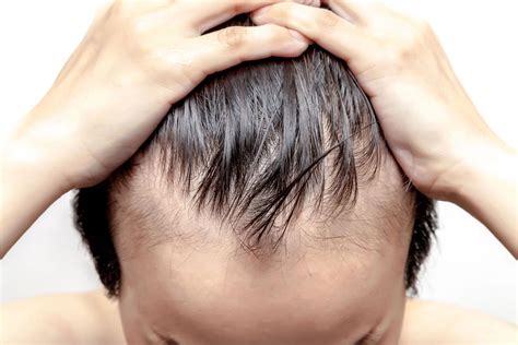 Baldness In Young Men Causes And Treatments Justinboey