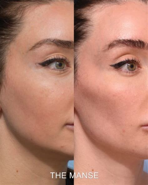 Cheek Fillers Before And After Sydney Dermal Filler Clinic