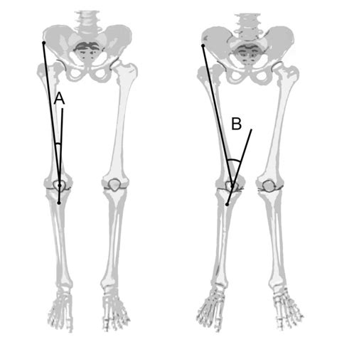 Q Angle Of Normal Knee Joint Is Close To 0° A Whereas In Valgus Knee