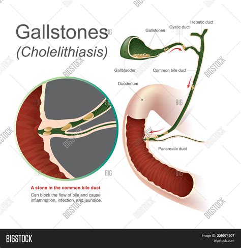 Stone Common Bile Duct Image And Photo Free Trial Bigstock