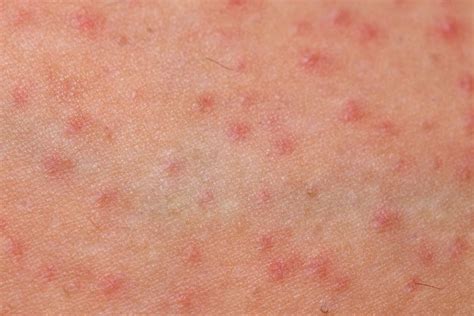 Folliculitis Causes Symptoms Treatment And Prevention