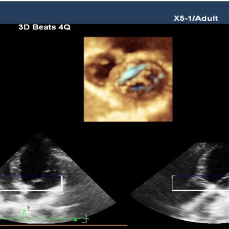 3d Echocardiography Which Shows A Double Orifice Mitral Valve Download Scientific Diagram
