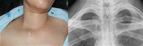 sternoclavicular joint dislocation serious concern or not a big deal — brown emergency medicine
