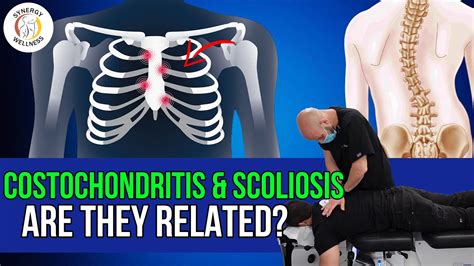Costochondritis And Scoliosis Are They Related Youtube