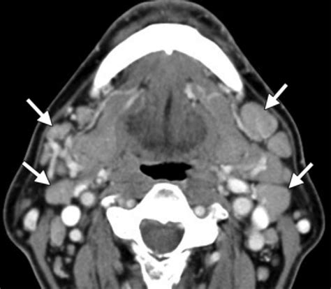 Igg4 Related Disease In A 63 Yearold Man With Bilateral Cervical