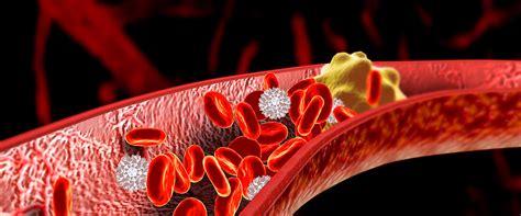 Unter thrombose wird eine komplikation betreffend das gefäßsystems beziehungsweise des blutes verstanden, bei dem ein blutgerinnsel, auch thrombus genannt, ein. Thrombose - Ursachen, Medikamente, Behandlung, Vorbeugen ...