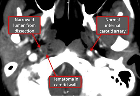 Carotid Dissection Causes Diagnosis And Treatment