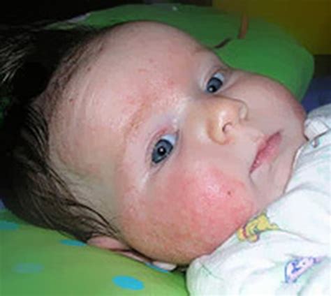 Eczema Atopic Dermatitis Skin Problems Homeopathy At