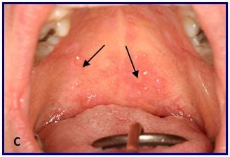 Having a bump on the roof of your mouth is not particularly uncommon.you have probably had them on your throat, lips, or tongue. Oral Chronic Graft-Versus-Host Disease