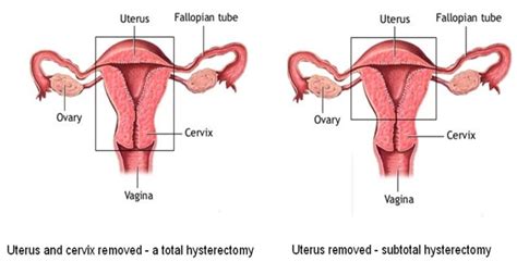 Laparoscopic Hysterectomy And Assisted Vaginal Hysterectomy